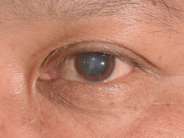 Cataract Surgery and Dry Eye Disease Treatment